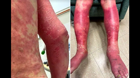 Skin Peeling Rash! Social Credit App In Our "Free World"...