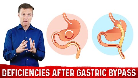 Nutritional Deficiencies after Weight Loss Surgery (Gastric Bypass / Bariatric Surgery) – Dr. Berg