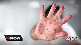 How to stay protected amid measles outbreak