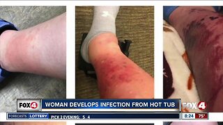 Hot tub causes infection on woman's legs