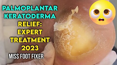 Palmoplantar Keratoderma Relief: Expert Treatment for Thick Callus Removal by miss foot fixer