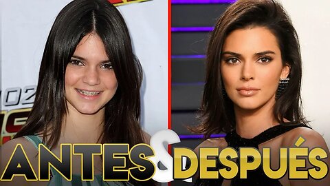 Kendall Jenner | Transformación Antes y Después | Cirugías Estéticas