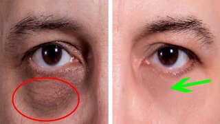 How to Get Rid of Bags Under Eyes and Dark Circles