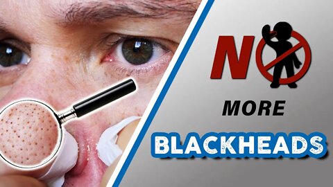 How to GET RID of BLACKHEADS for men