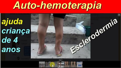 AUTO-HEMOTERAPIA AJUDA CRIANÇA DE 4 ANOS PORTADORA DE ESCLERODERMIA, paciente do Dr. Luiz Moura
