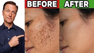 Remove Hyperpigmentation (Aging or Darkspots) Quickly and Easily!