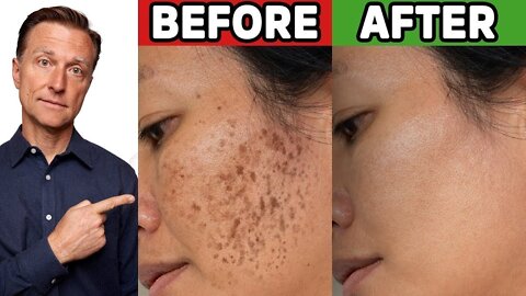 Remove Hyperpigmentation (Aging or Darkspots) Quickly and Easily!