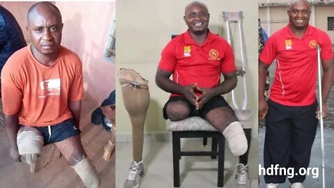 Mr. Eze Ugbonna an Amputee Gets 2 Prostheses from @Hosanna David Foundation
