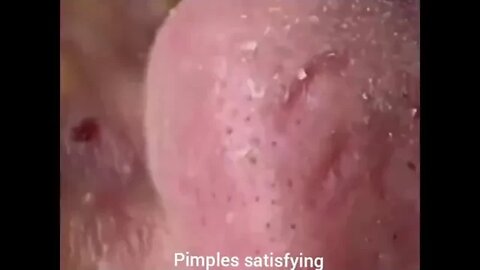 Removal of blackheads and pimples.