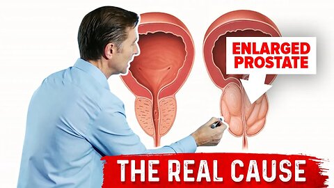 Enlarged Prostate and Urination Problems Explained by Dr.Berg