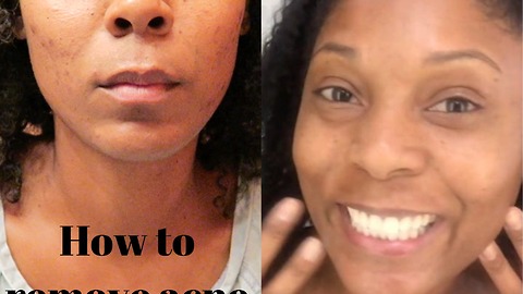How to remove acne scars with microneedling
