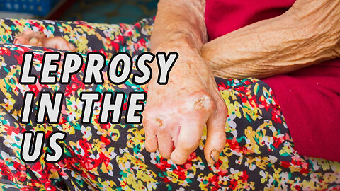 Leprosy cases increasing in the United States