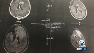 St. Lucie County glioblastoma patients fear something local could be causing their illness