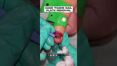 HAND THUMB NAIL PLATE REMOVAL [ NAIL AVULSION ] BY FOOT SPECIALIST MISS FOOT FIXER