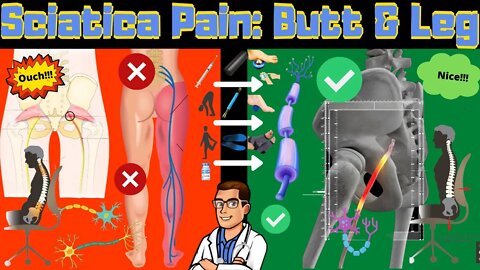 How To Cure Sciatica Permanently [Treatment, Stretches, Exercises]