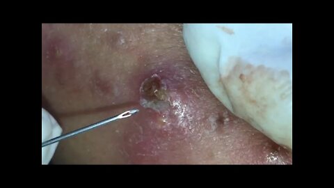 Blackheads & Milia, Big Cystic Acne Blackheads Extraction Whiteheads Removal Pimple Popping