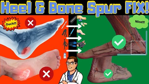 What is a Heel Bone Spur? [Foot & Heel Spur Treatment & Home Remedies]