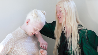 The Besties With Albinism | BORN DIFFERENT