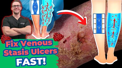 Venous Stasis Dermatitis & Venous Ulcers Treatment! [Varicose Veins]
