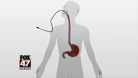 @Swisstrong: A New Treatment for Esophageal Cancer