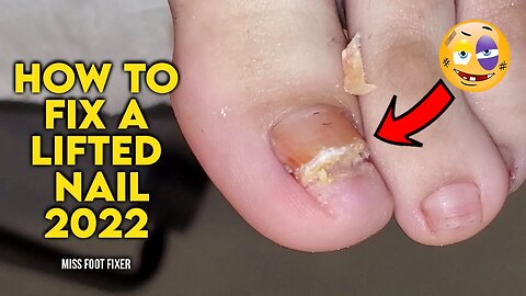 HOW TO FIX A LIFTED NAIL 2022 [ Thick Lifted Toenails] BY FOOT DOCTOR MISS FOOT FIXER