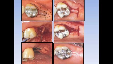 Periodontics L7 Part2 (Periodental Surgery)