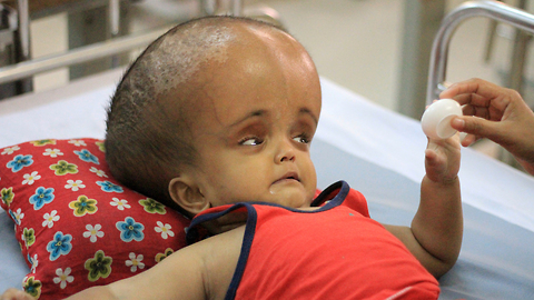 Baby With Swollen Head Hopes For Life-Saving Surgery: BORN DIFFERENT