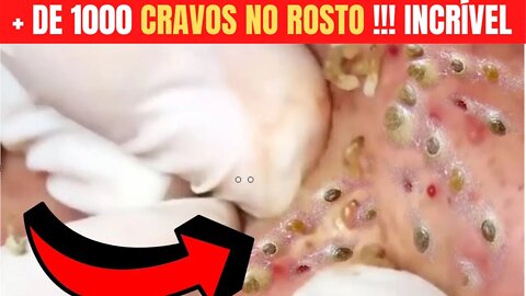 ESPREMENDO CRAVOS E ESPINHAS GIGANTESCAS Removendo Cravos e Espinhas do Rosto PIMPLE EXTRACTION