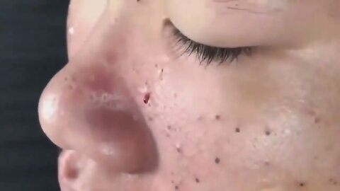 Satisfying BLACKHEAD REMOVAL all over the face!!!