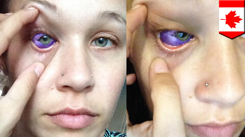 Eye tattoo gone wrong: Model’s eyeball inking results in vision loss - TomoNews