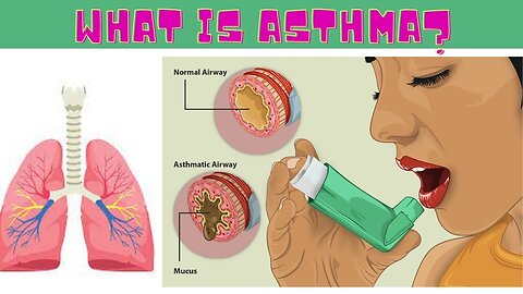 What is Asthma? Causes, Signs and Symptoms | Diagnosis of Asthma