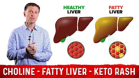 Choline: One of The Best Vitamins for Fatty Liver – Dr. Berg