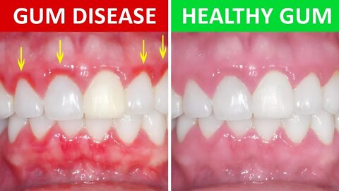 How to Get Rid of Gingivitis at Home (Gum Disease)