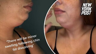 I got my chin fat dissolved — I ended up looking like a 'frog'