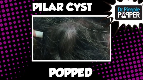 Popping a GREAT Pilar Cyst