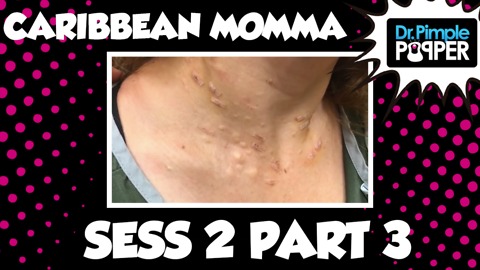Caribbean Momma and her Steatocystomas: Session Two, Part Three (plus PIMPLE PETE)
