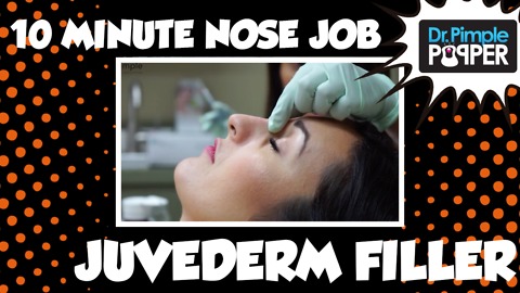 10 Minute Nose Job - Juvederm Filler