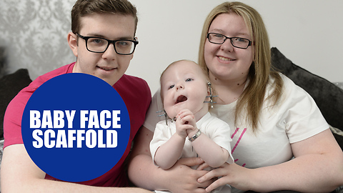 Baby boy became the first in the world to undergo a miracle face operation