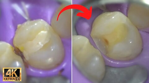 Tooth Cavity Removal | Repairing Tooth Decay with dental filling