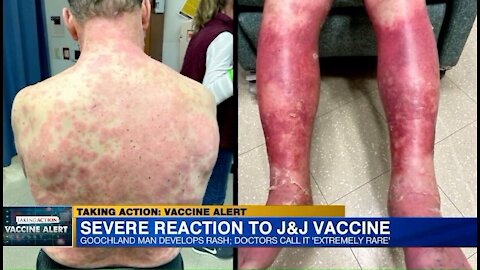 Virginia Man Suffers Severe Reaction To Covid-19 Vaccine