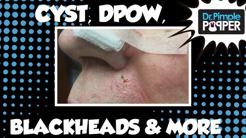 Cysts, Dilated Pore of Winer, Blackheads & more! | Medley