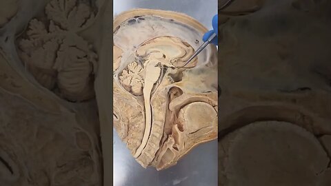 REAL Human Pituitary Gland