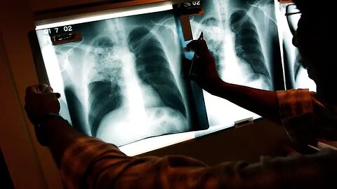 US tuberculosis cases in 2023 were at highest level in a decade, CDC says