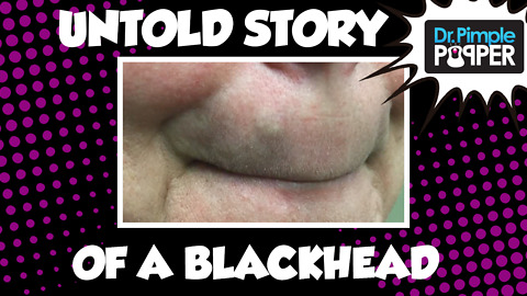The UNTOLD story of the Button Blackhead