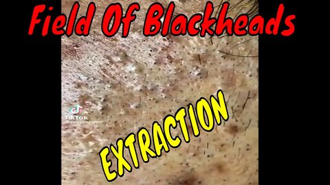 Field of blackheads gets extracted 😳 #blackheadremoval #blackhead #blackheads #satisfying #fypage