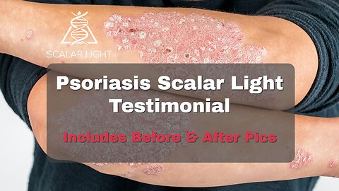 Psoriasis Scalar Light Testimonial - Includes Before & After Pics