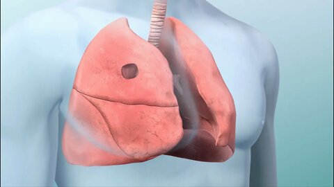 Cómo controlar el cáncer de pulmón