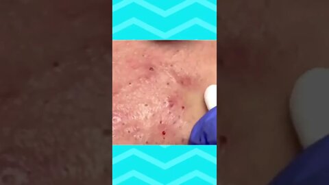 Blackheads and Pimples Removal Skin Cleansing #2 Relaxing Videos #short