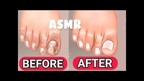 ASMR Ingrown Toenail Treatment Animation l Removal Bad Nail l Cut l Polish l Etc....