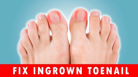 How to Fix Ingrown Toenails at Home
